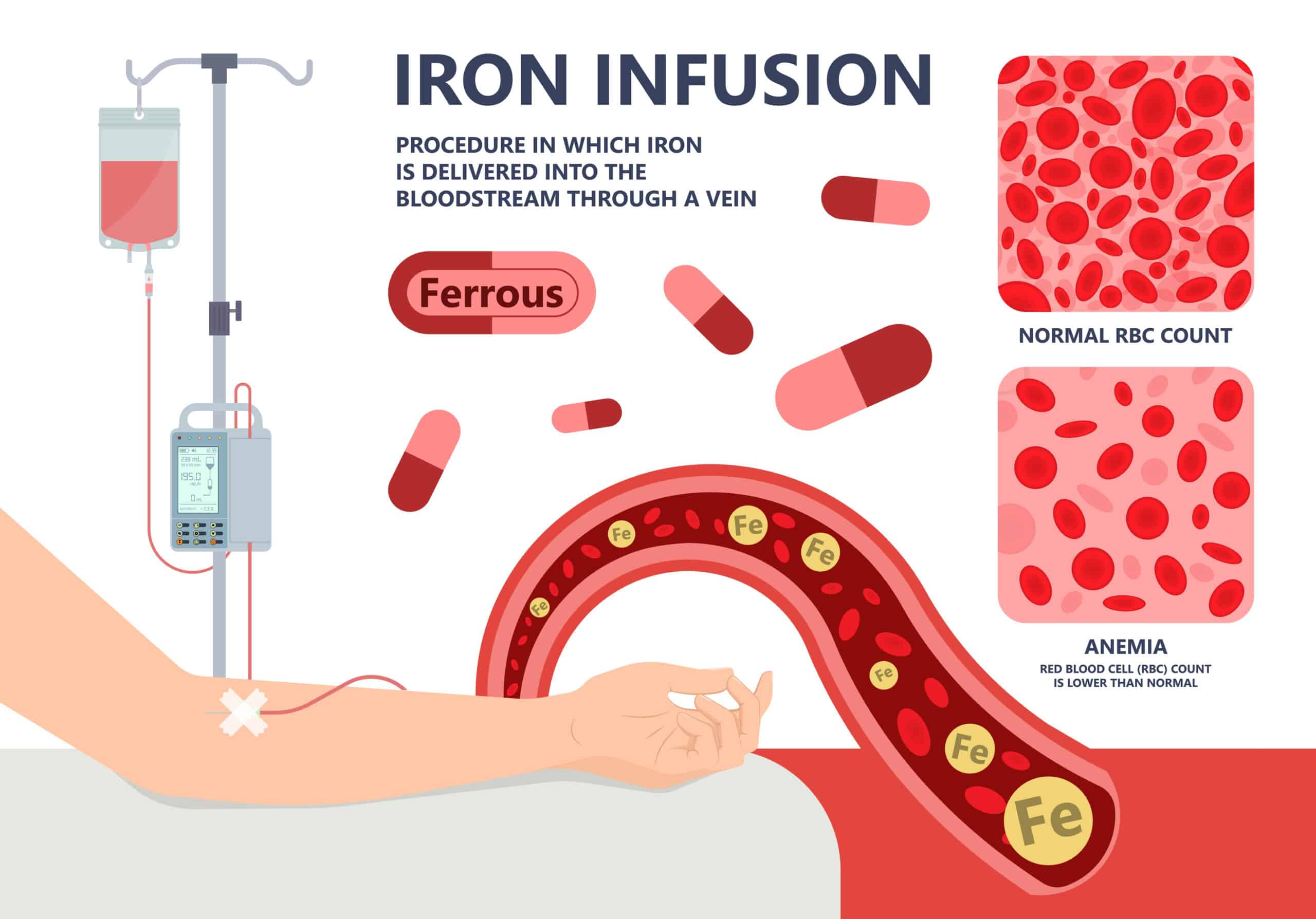 A diagram depicting iron infusion into the blood via iv drip